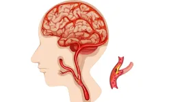 Carotid artery disease & Stroke